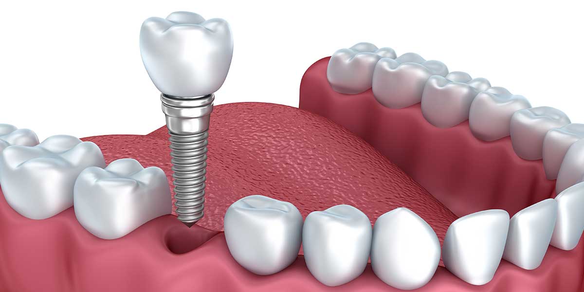 an-overview-of-dental-implant-procedure-steps-family-dentistry-of